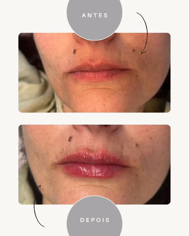 Depois - Preenchimento Labial