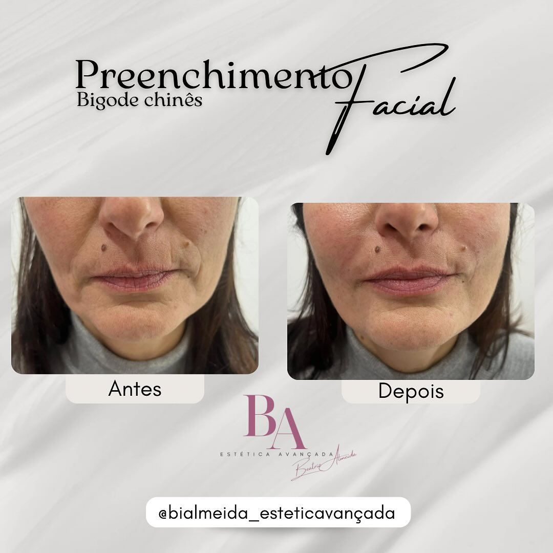 Preenchimento Facial