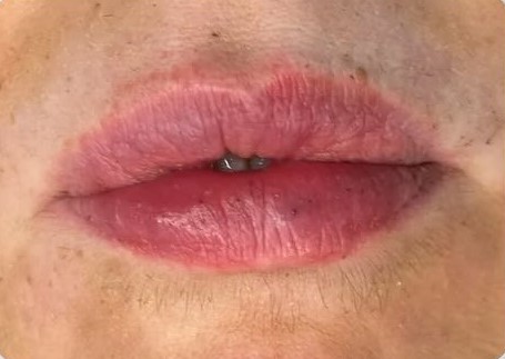 Antes - Preenchimento Labial